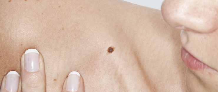 How to Check your Moles for Signs of Skin Cancer