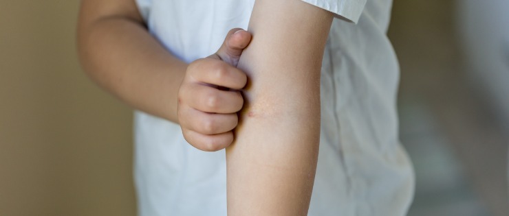 Child scratching their arm as a result of an allergic reaction to food.