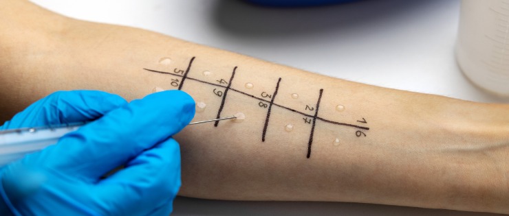 A doctor performing a skin prick test on a patient’s arm to diagnose a food allergy.
