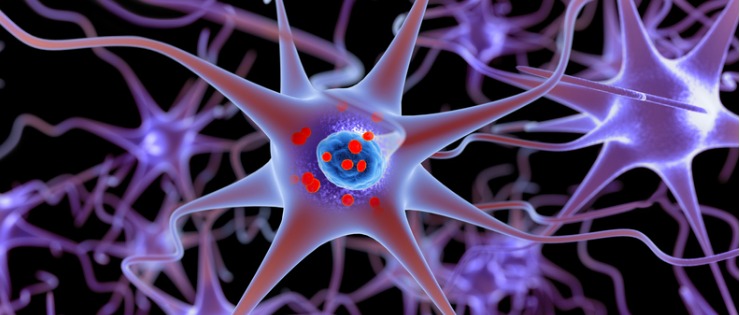 3D diagram of showing loss of dopamine-producing brain cells causing PD