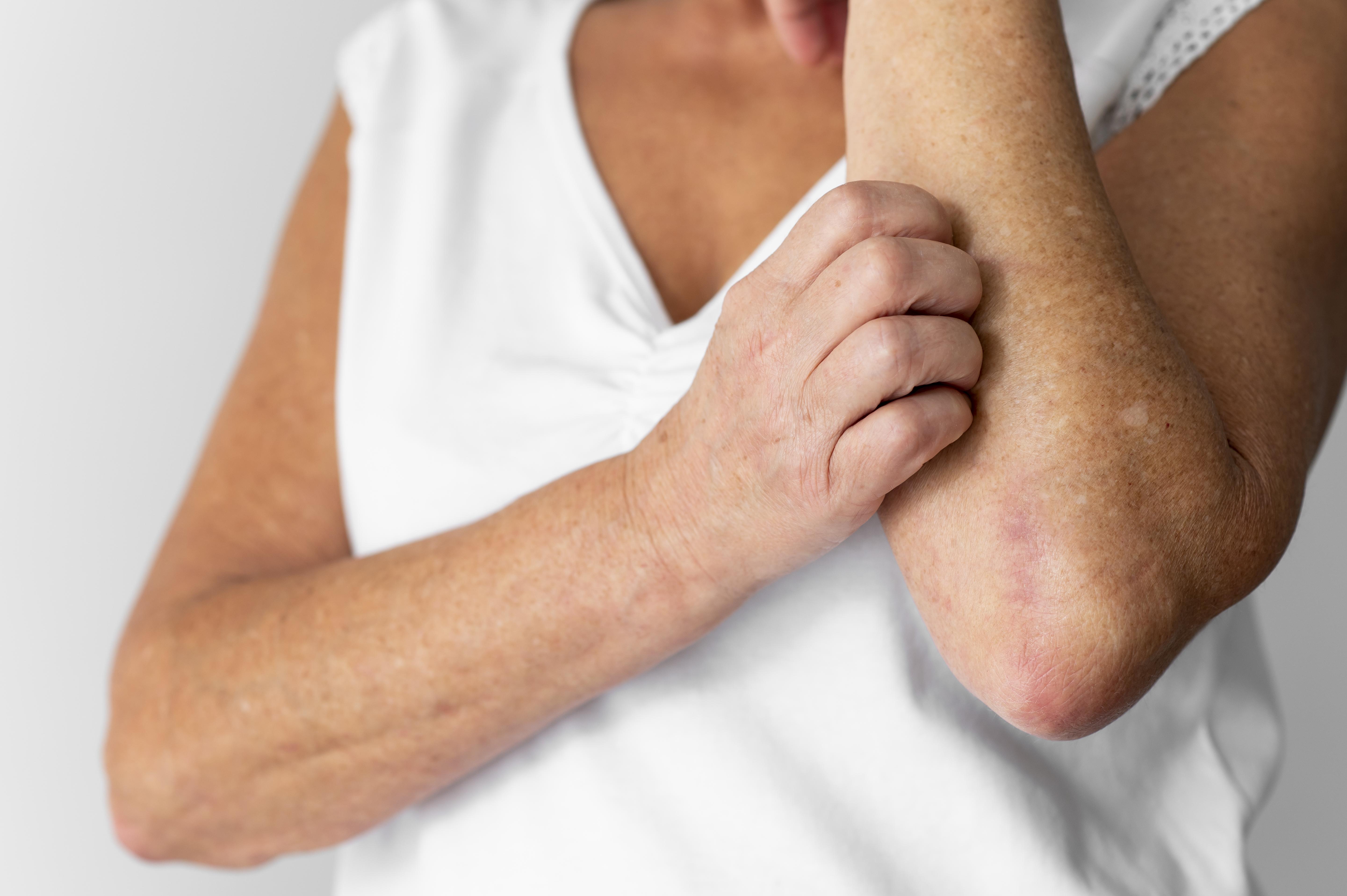 What Is Dermatitis and What Does It Mean for Your Skin’s Health?