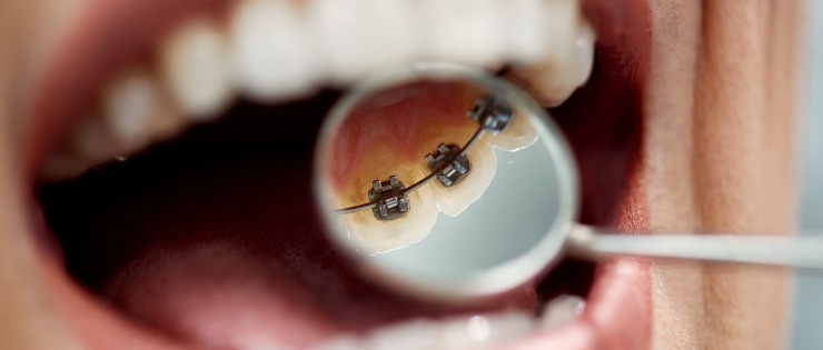 A person receiving braces after a series of teledentistry consults with their orthodontist.