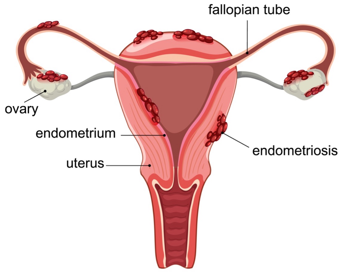 Medical illustration of endometriosis