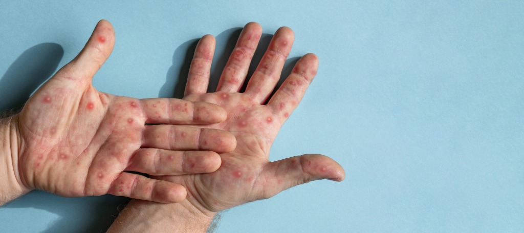 A person infected with monkeypox, as seen by the symptom of rashes on their hands